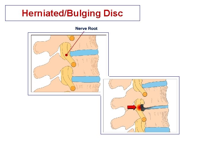 Herniated/Bulging Disc 