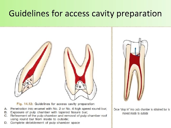 Guidelines for access cavity preparation 