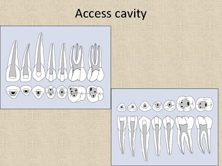 Access cavity 