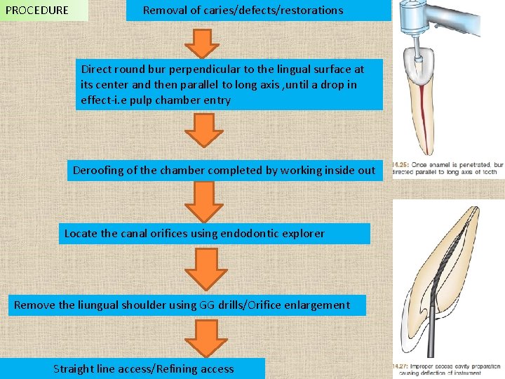 PROCEDURE Removal of caries/defects/restorations Direct round bur perpendicular to the lingual surface at its