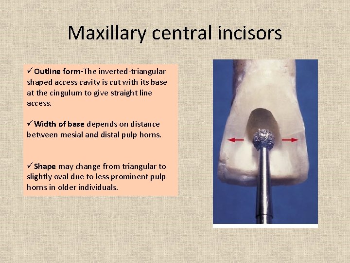 Maxillary central incisors üOutline form-The inverted-triangular shaped access cavity is cut with its base