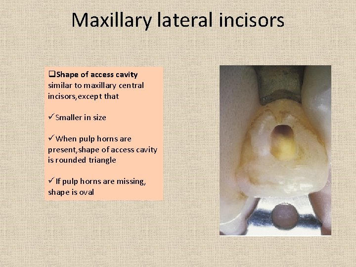 Maxillary lateral incisors q. Shape of access cavity similar to maxillary central incisors, except