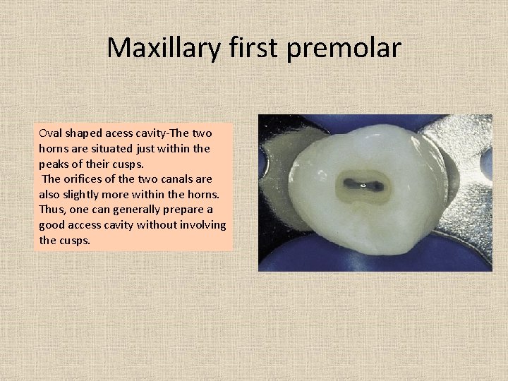 Maxillary first premolar Oval shaped acess cavity-The two horns are situated just within the