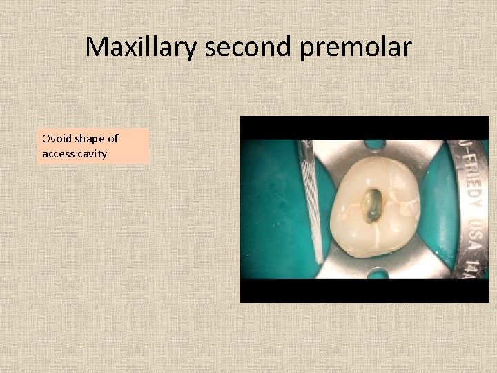 Maxillary second premolar Ovoid shape of access cavity 