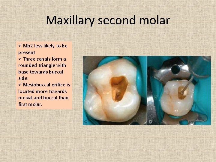 Maxillary second molar üMb 2 less likely to be present üThree canals form a