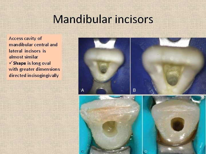 Mandibular incisors Access cavity of mandibular central and lateral incisors is almost similar üShape