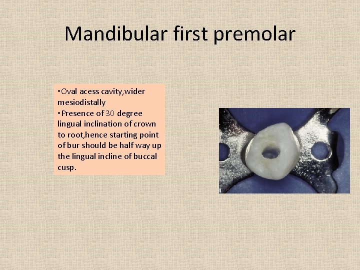 Mandibular first premolar • Oval acess cavity, wider mesiodistally • Presence of 30 degree