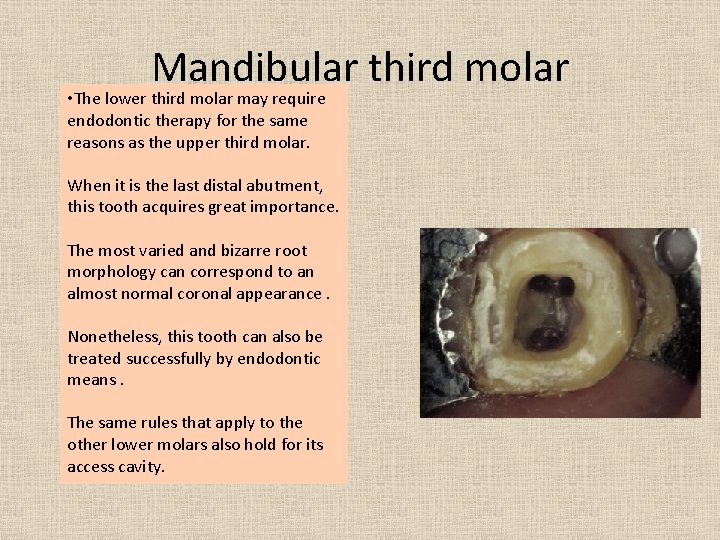 Mandibular third molar • The lower third molar may require endodontic therapy for the