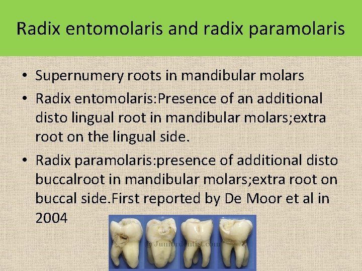 Radix entomolaris and radix paramolaris • Supernumery roots in mandibular molars • Radix entomolaris: