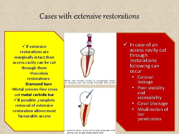 Cases with extensive restorations üIf extensive restorations are marginally intact, then access cavity can