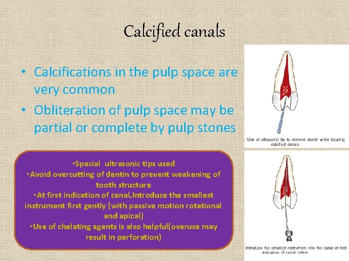 Calcified canals • Calcifications in the pulp space are very common • Obliteration of