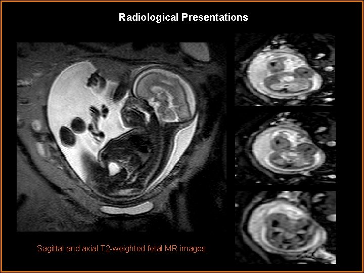 Radiological Presentations Sagittal and axial T 2 -weighted fetal MR images. 