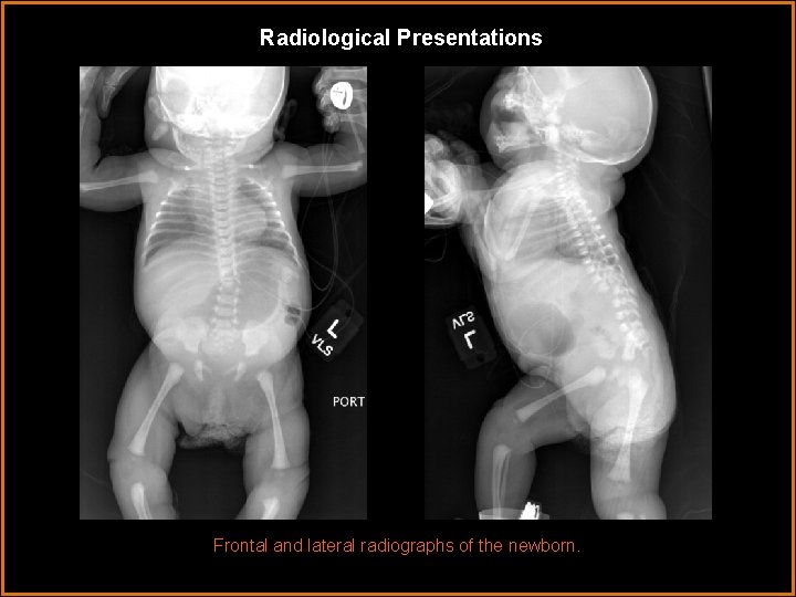 Radiological Presentations Frontal and lateral radiographs of the newborn. 