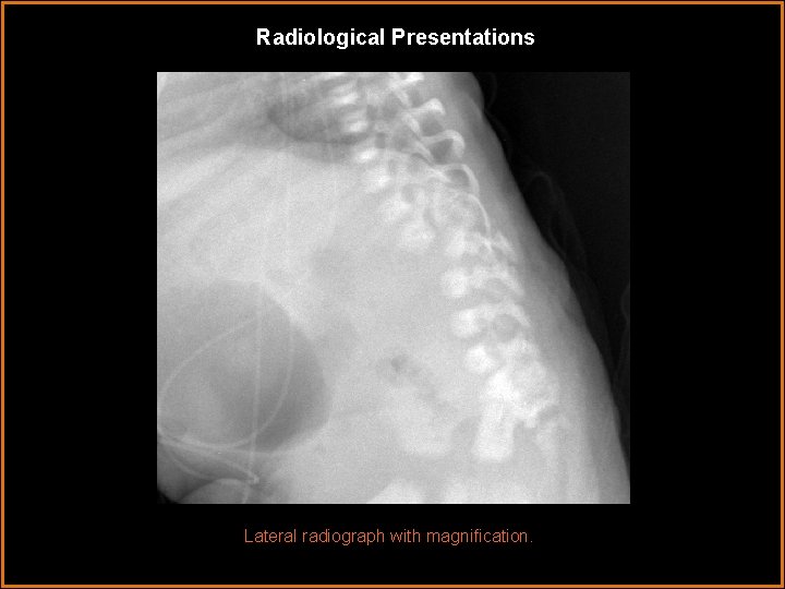 Radiological Presentations Lateral radiograph with magnification. 