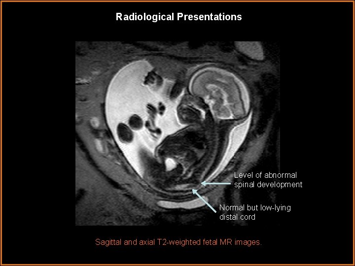 Radiological Presentations Level of abnormal spinal development Normal but low-lying distal cord Sagittal and