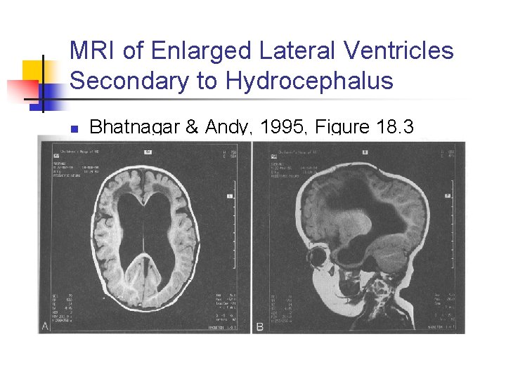 MRI of Enlarged Lateral Ventricles Secondary to Hydrocephalus n Bhatnagar & Andy, 1995, Figure