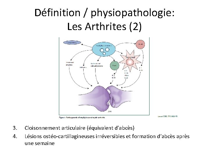 Définition / physiopathologie: Les Arthrites (2) 3. 4. Cloisonnement articulaire (équivalent d’abcès) Lésions ostéo-cartillagineuses