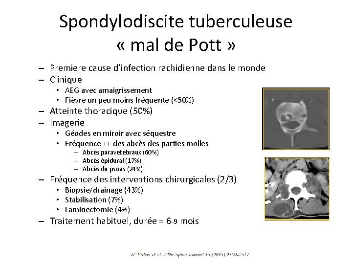 Spondylodiscite tuberculeuse « mal de Pott » – Premiere cause d’infection rachidienne dans le