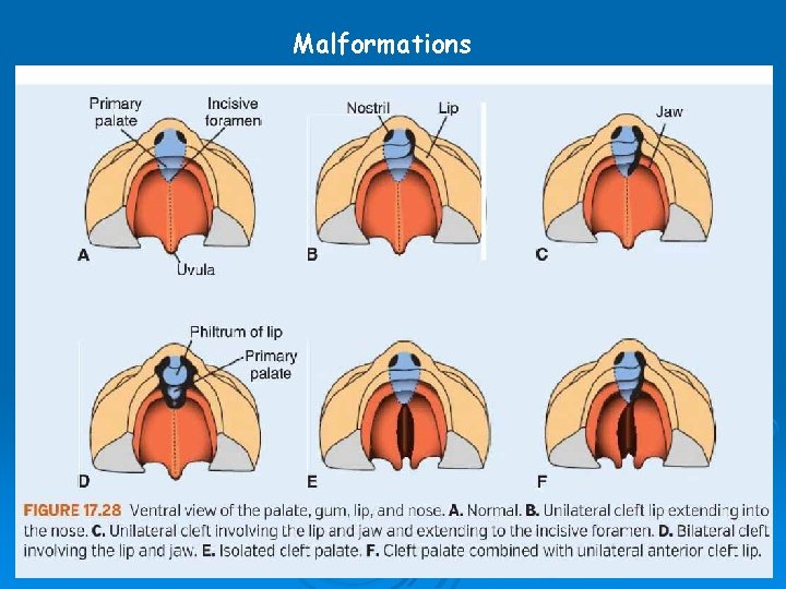 Malformations 