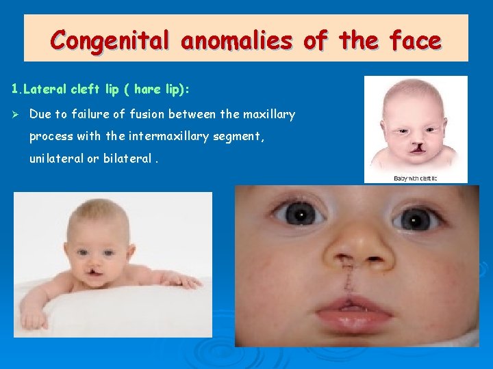 Congenital anomalies of the face 1. Lateral cleft lip ( hare lip): Ø Due