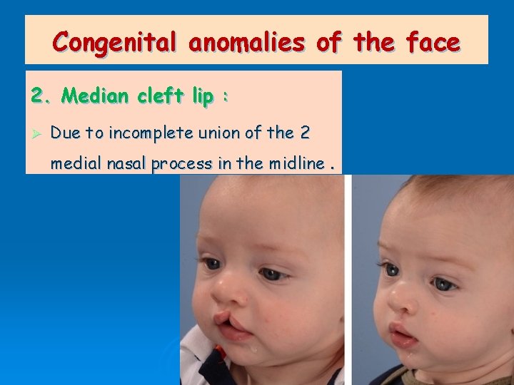 Congenital anomalies of the face 2. Median cleft lip : Ø Due to incomplete