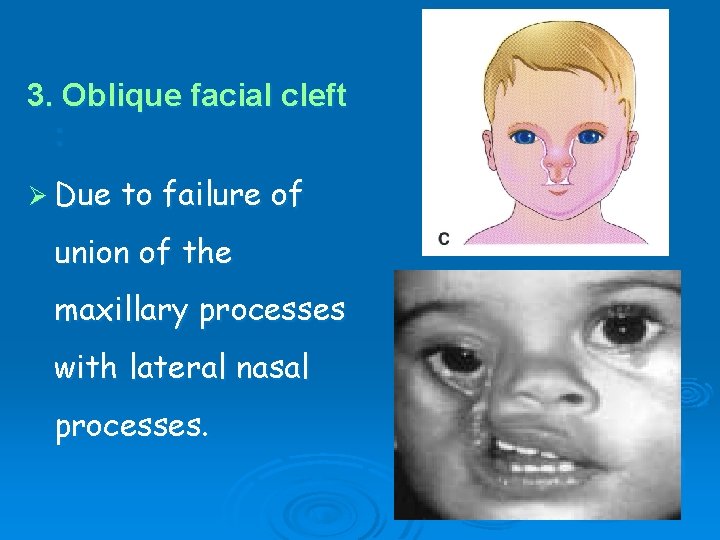 3. Oblique facial cleft : Ø Due to failure of union of the maxillary