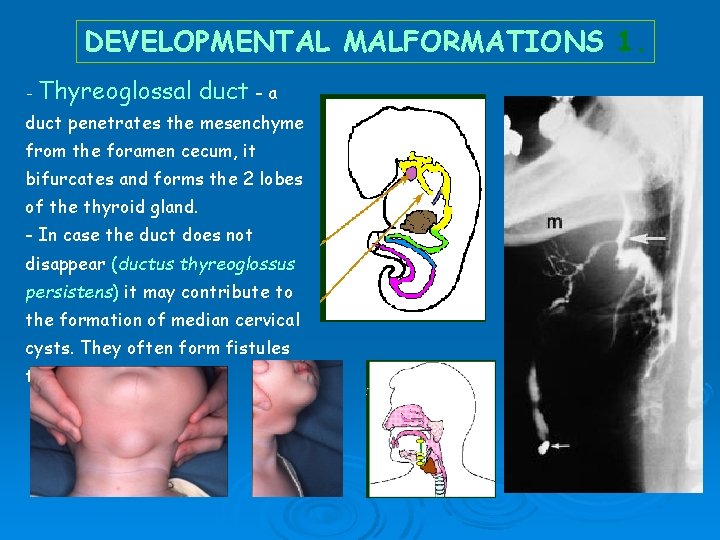 DEVELOPMENTAL MALFORMATIONS 1. - Thyreoglossal duct - a duct penetrates the mesenchyme from the