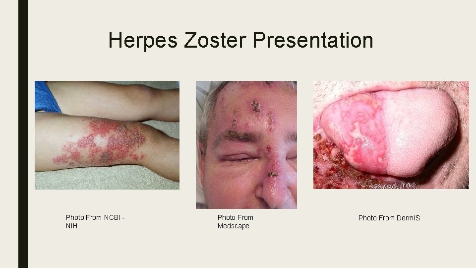Herpes Zoster Presentation Photo From NCBI - NIH Photo From Medscape Photo From Derm.