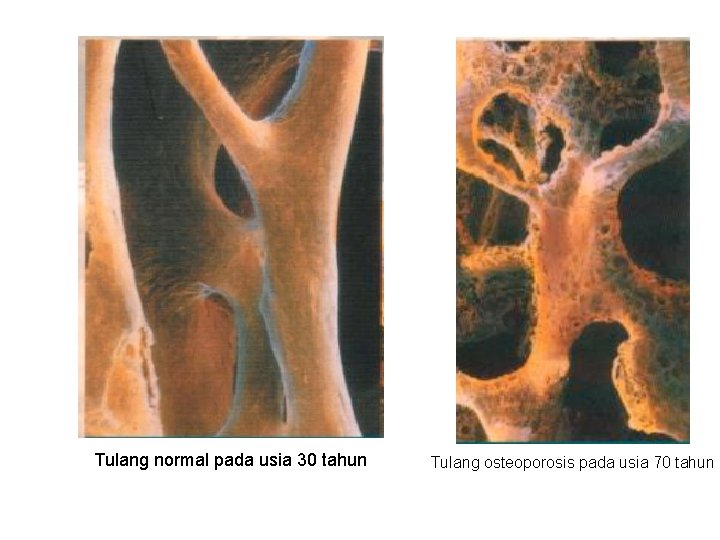 Tulang normal pada usia 30 tahun Tulang osteoporosis pada usia 70 tahun 