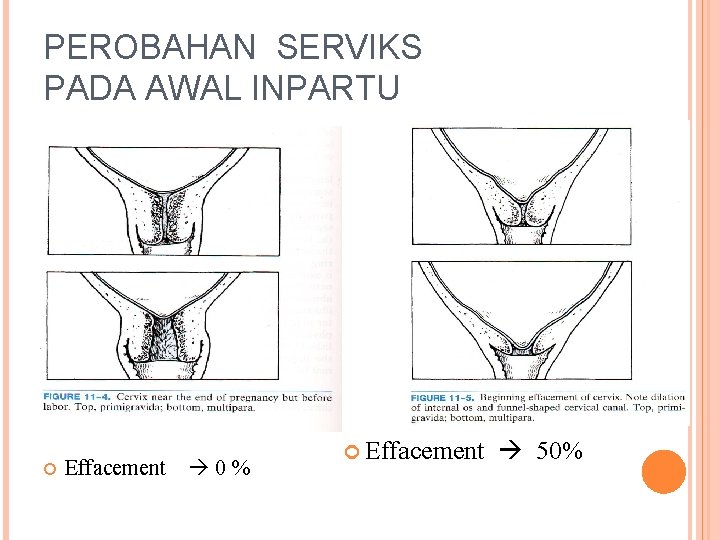 PEROBAHAN SERVIKS PADA AWAL INPARTU Effacement 0 % Effacement 50% 