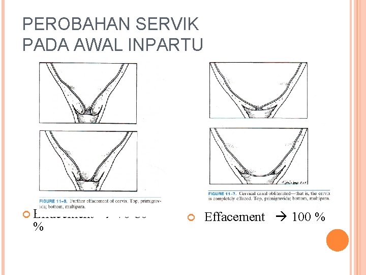 PEROBAHAN SERVIK PADA AWAL INPARTU Effacement 70 -80 % Effacement 100 % 