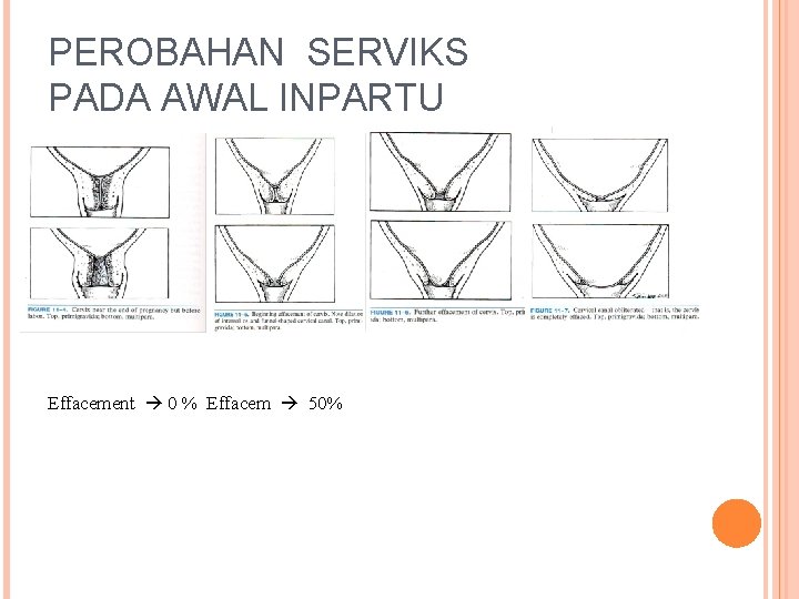 PEROBAHAN SERVIKS PADA AWAL INPARTU Effacement 0 % Effacem 50% 