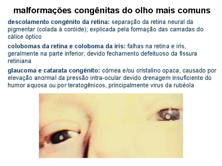 malformações congênitas do olho mais comuns descolamento congênito da retina: separação da retina neural