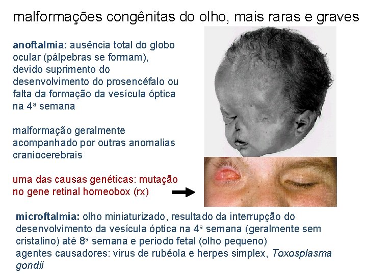 malformações congênitas do olho, mais raras e graves anoftalmia: ausência total do globo ocular