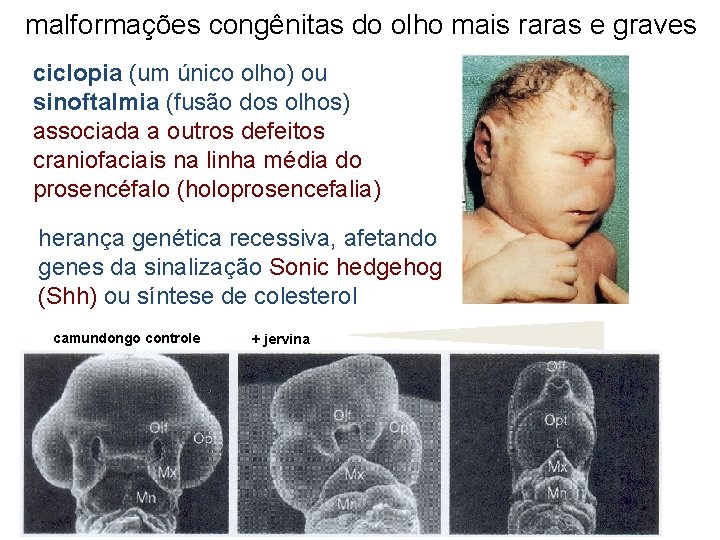 malformações congênitas do olho mais raras e graves ciclopia (um único olho) ou sinoftalmia