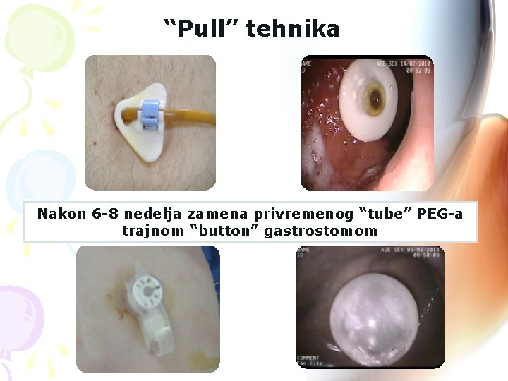 “Pull” tehnika Nakon 6 -8 nedelja zamena privremenog “tube” PEG-a trajnom “button” gastrostomom 