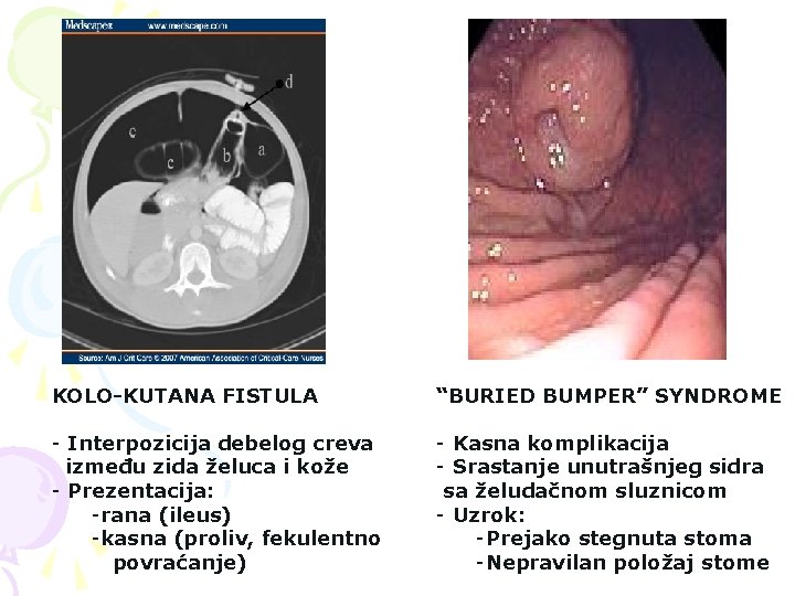 KOLO-KUTANA FISTULA “BURIED BUMPER” SYNDROME - Interpozicija debelog creva između zida želuca i kože