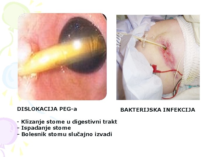 DISLOKACIJA PEG-a - Klizanje stome u digestivni trakt - Ispadanje stome - Bolesnik stomu