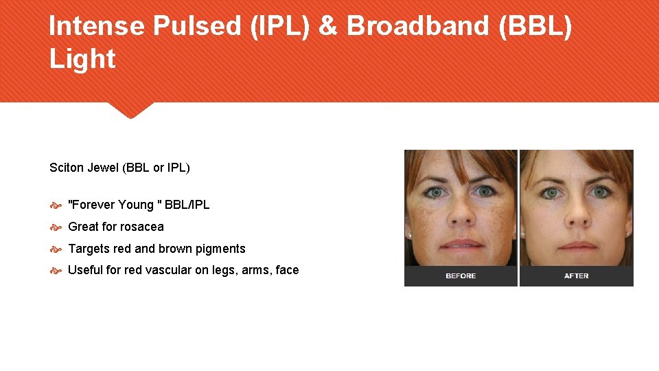 Intense Pulsed (IPL) & Broadband (BBL) Light Sciton Jewel (BBL or IPL) "Forever Young