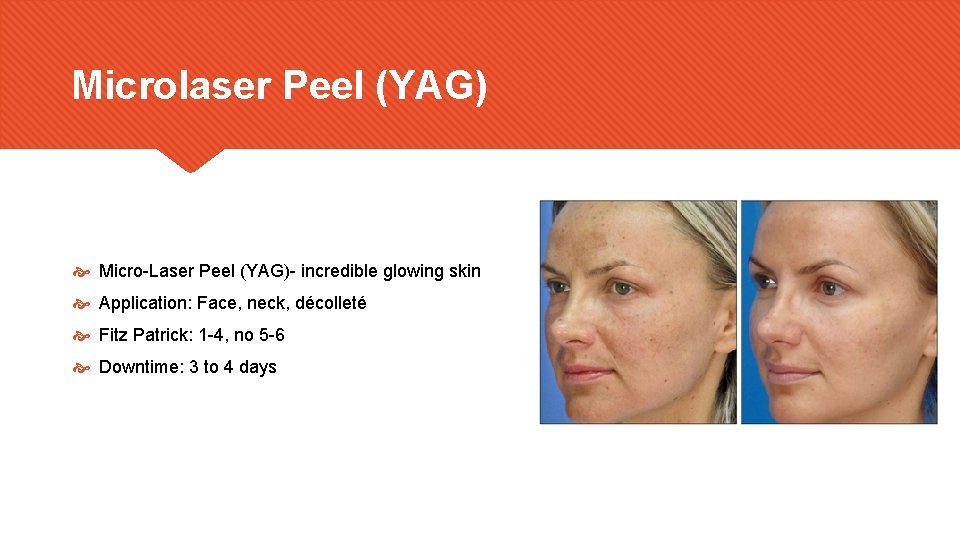 Microlaser Peel (YAG) Micro-Laser Peel (YAG)- incredible glowing skin Application: Face, neck, décolleté Fitz