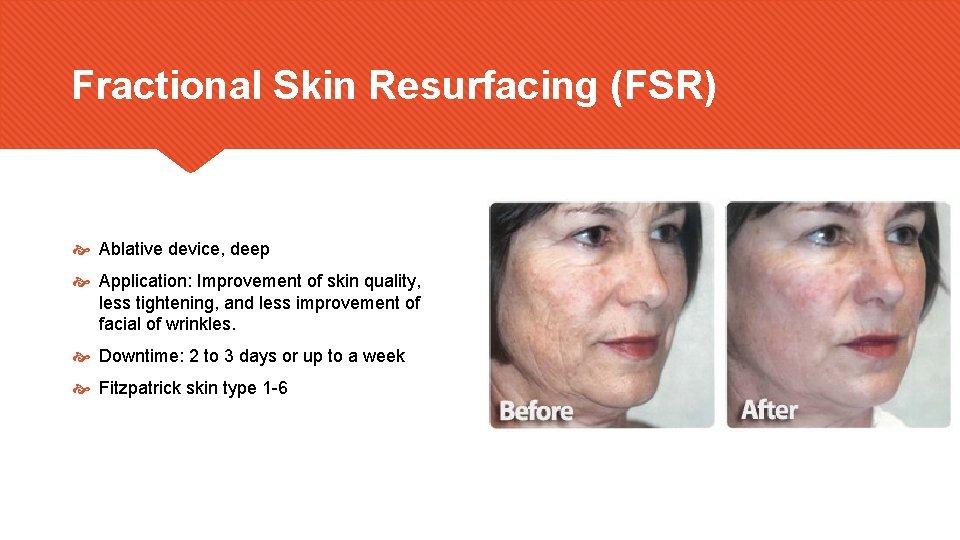 Fractional Skin Resurfacing (FSR) Ablative device, deep Application: Improvement of skin quality, less tightening,
