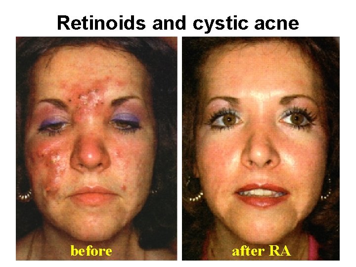 retinoid cystic acne