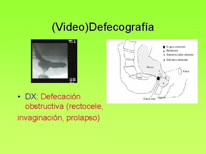 (Video)Defecografía • DX: Defecación obstructiva (rectocele, invaginación, prolapso) 