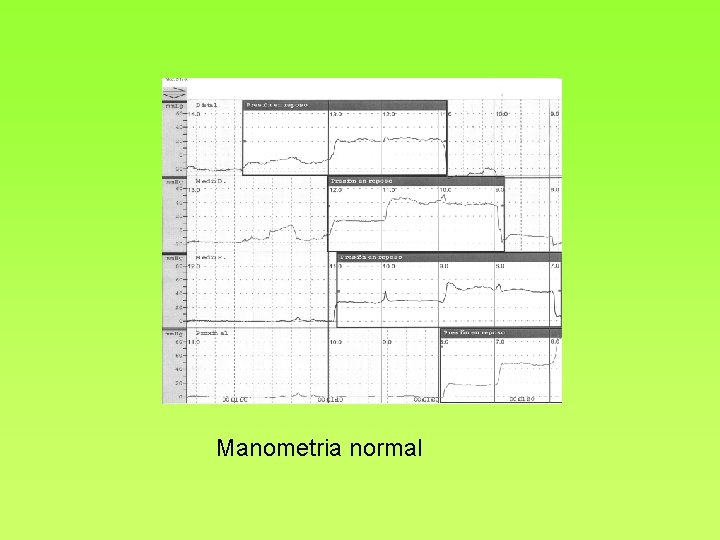 Manometria normal 