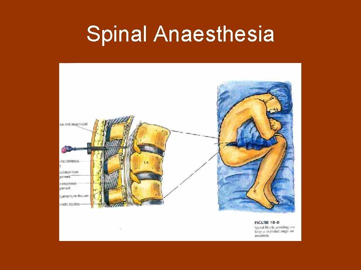 Spinal Anaesthesia 