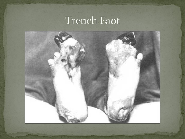 Trench Foot 