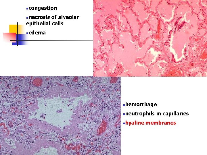 ncongestion nnecrosis of alveolar epithelial cells nedema nhemorrhage nneutrophils nhyaline in capillaries membranes 
