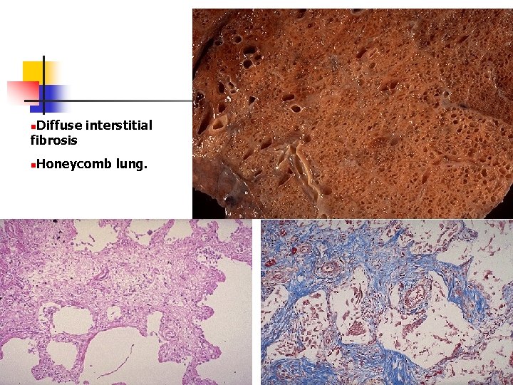 Diffuse interstitial fibrosis n Honeycomb lung. n 