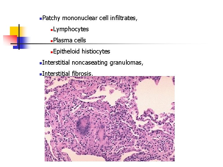 n Patchy mononuclear cell infiltrates, n Lymphocytes n Plasma cells n Epitheloid histiocytes n