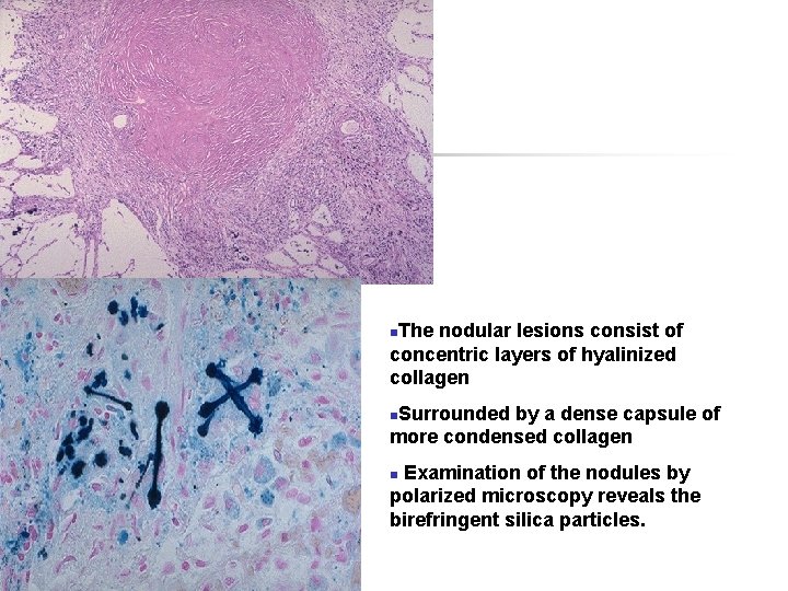 n. The nodular lesions consist of concentric layers of hyalinized collagen n. Surrounded by